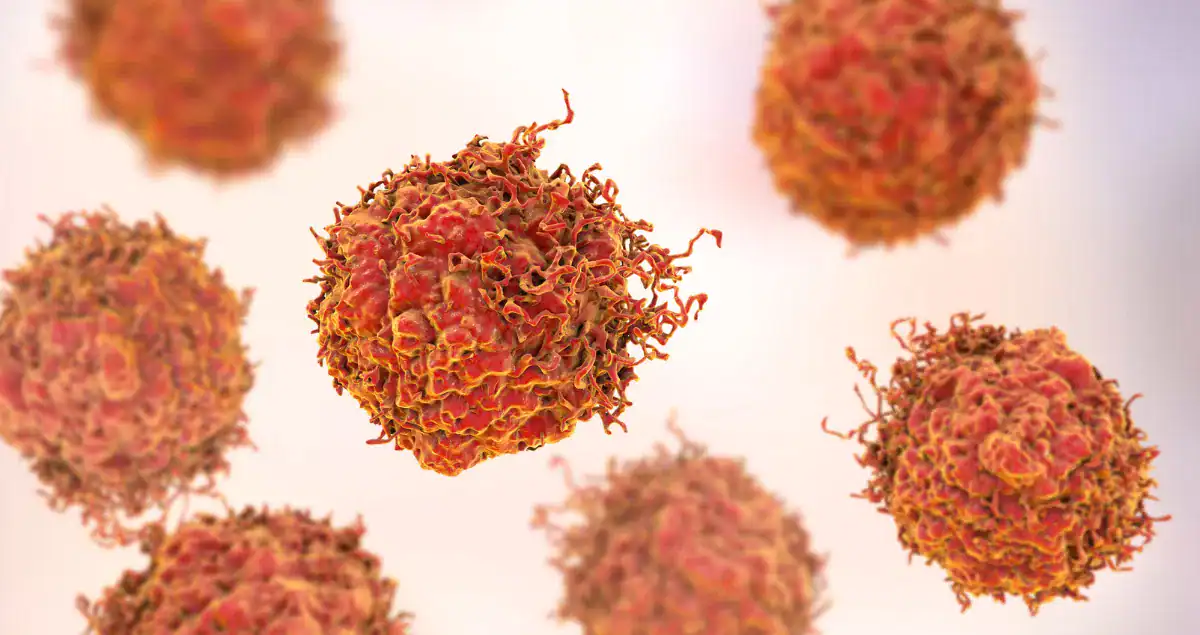 Why Microinvasion Matters in Breast Cancer