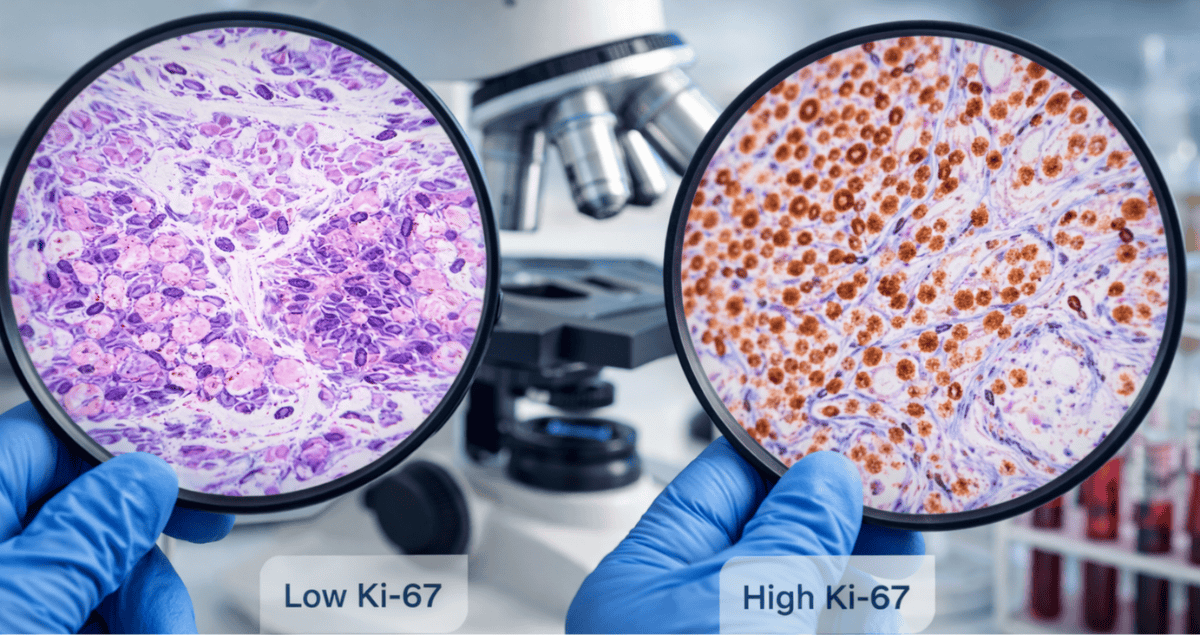 What Is Considered a “High” or “Low” Ki-67?