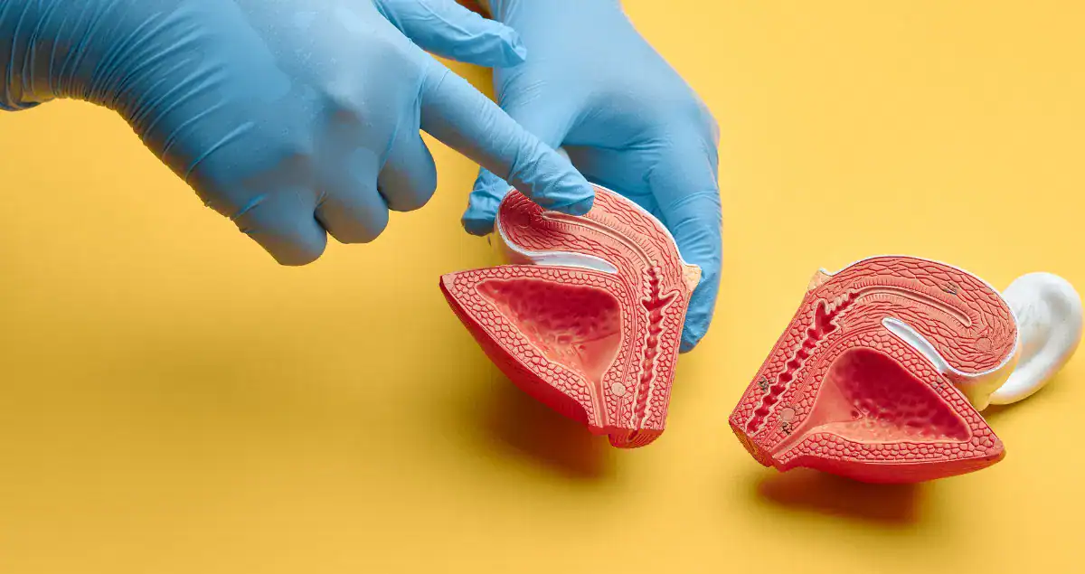 High-Grade Dysplasia in the Bladder: Detection, Risks, and Follow-Up