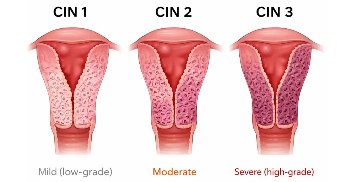 What does CIN 1 vs CIN 2 vs CIN 3 mean?
