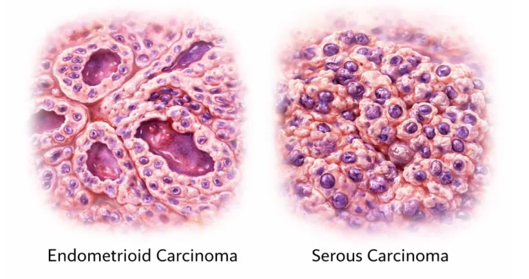 What does endometrioid vs serous carcinoma mean?