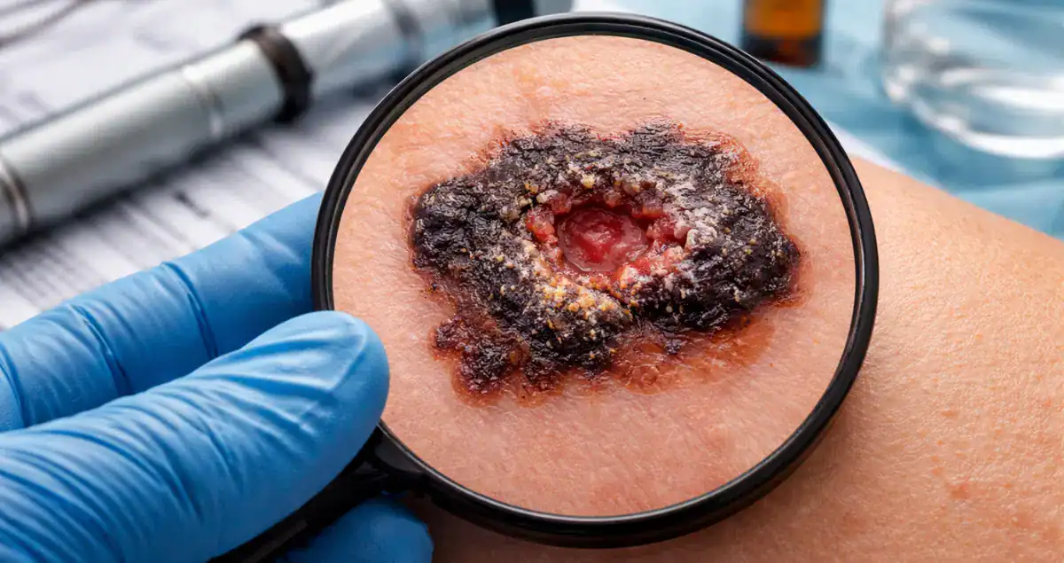 What does ulceration mean in melanoma?