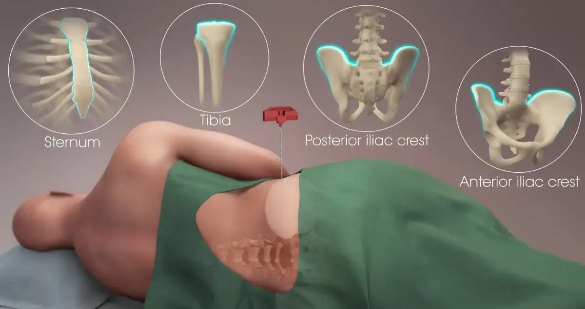 What does bone marrow biopsy confirm?