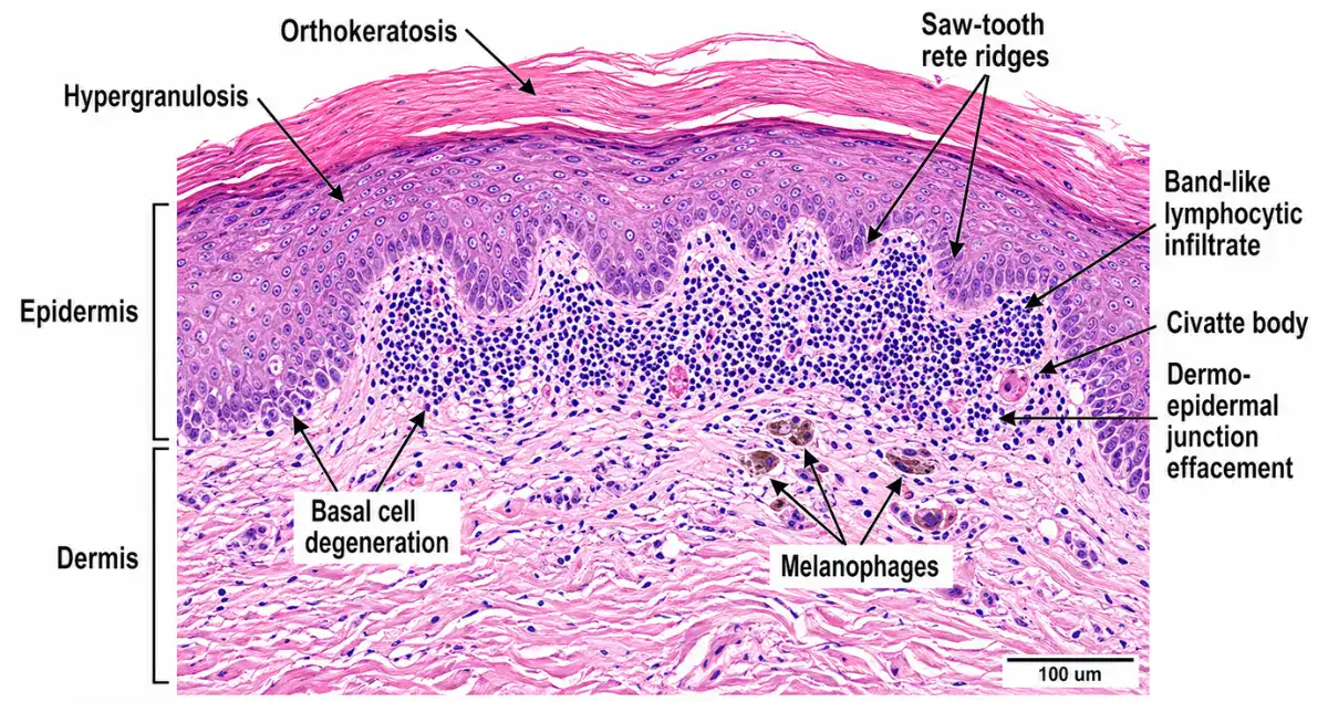 Microscopic skin biopsy showing lichenoid reaction features including basal cell damage and band-like inflammation.