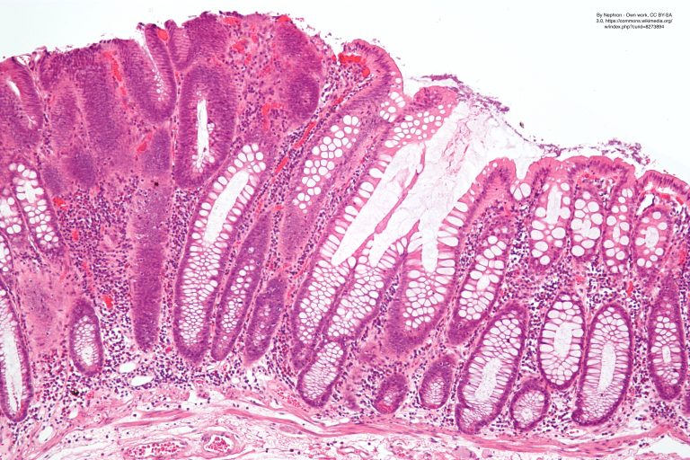 Tubular vs Tubulovillous Adenoma: What Does the Colon Polyp Report Mean?